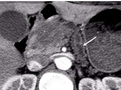 Figure 1: Aspect scanographique de l’adénocarcinome pancréatique  Masse  pancréatique  céphalique  hypodense  au  temps  artériel,  mal  limitée  et  déformant  les  contours  de  la  glande  avec  dilatation  canalaire  (flèche  blanche)  et  atrophie du 