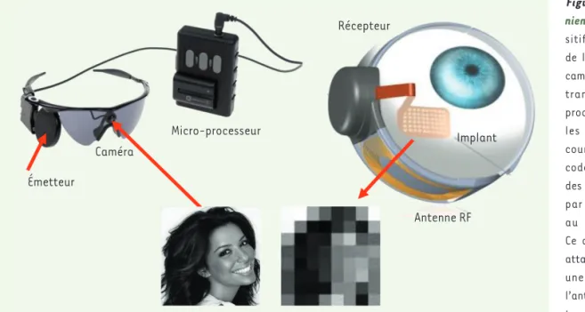 Figure 1. Prothèse réti- réti-nienne  Argus II. Le  dispo-sitif comprend une paire  de lunettes sur laquelle la  caméra produit des images  transmises à un  micro-processeur qui transforme  les images en codes de  courants électriques