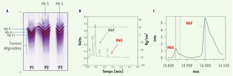 Figure 2. Différentes techniques d’étude de l’hémoglobine. A. Étude de l’hémoglobine par isoélectrofocalisation (IEF)