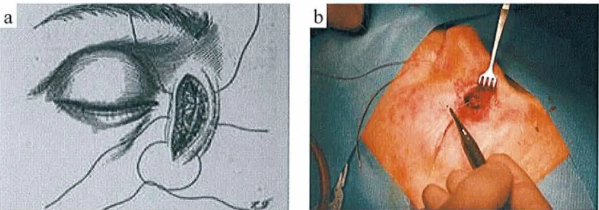 Figure 8.Suture du lambeau du sac lacrymal  à  la muqueuse nasale (a et b). 