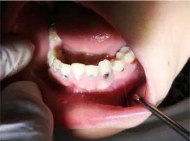 Figure 10 : Caries de Löwenthal débutantes. 