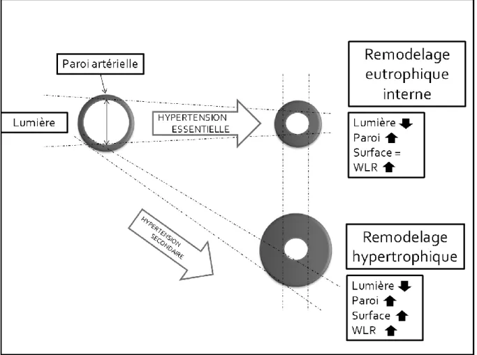 Figure 1 Aspects du remodelage microvasculaire dans l’hypertension artérielle  1.1.2 Hypertension et macrocirculation 