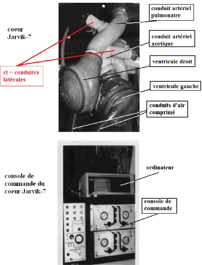 Figure 1. Le cœur artificiel Jarvik-7-100 et sa console de commande. 