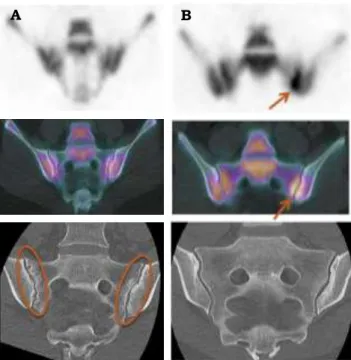 Figure 1. Two examples of discordance between PET/CT and CT-scan. A negative PET/CT with  structural sacroiliitis on CT-scan and multiple erosions (A), and a positive PET/CT without structural 