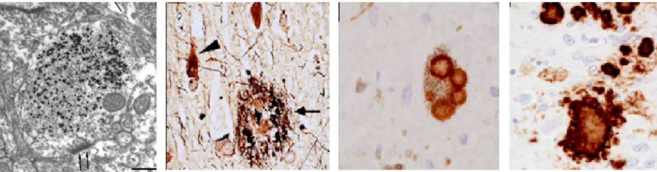Figure 8  : Clichés représentant les agrégats de protéines dans les pathologies  neurodégénératives