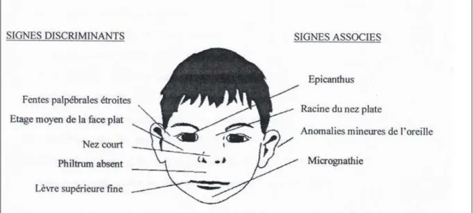 Figure 5 : Les signes de la dysmorphie faciale caractéristique d'un enfant SAF.