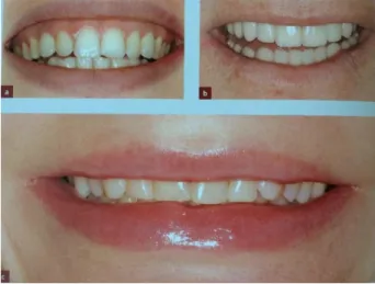 Figure 3 : a- sourire gingival, b- ligne du sourire moyenne, c- Ligne du sourire basse (15) 