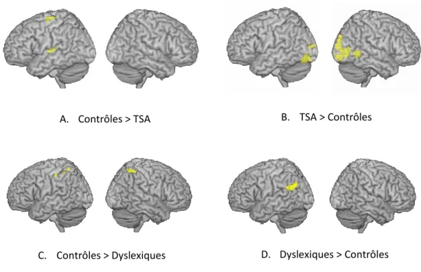 Figure 28 : Comparaison de l’activité neurale (BOLD) chez 13 sujets atteints de troubles du  spectre  autistique,  12  sujets  dyslexiques  et  13  sujets  contrôles  non  affectés,  pendant  la  visualisation  d’un  documentaire  scientifique  pour  enfan