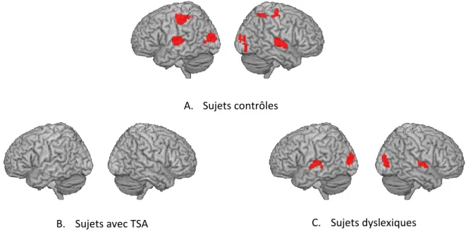 Figure 29: Activité neurale BOLD en réponse à l’enveloppe du son de parole du film chez 13  sujets  contrôles  (A),  13  sujets  avec  TSA  (B)  et  12  sujets  dyslexiques  (C)  (p&lt;0.001  non  corrigé)