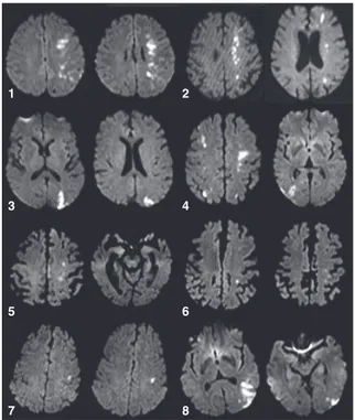 Figure 1 Cerebral diffusion-weighted MRI of the border-zone infarctions (BZI) associated with aphasia