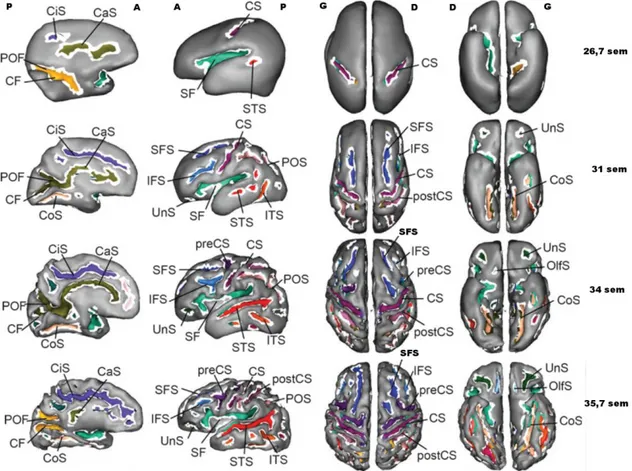 Figure  5.  Illustration  de  l’apparition  des  sillons  sur  l’interface  gris-blanc  de  cerveaux  de  nouveau-nés  prématurés  d’âge  gestationnel  et  de  niveau  de  sulcation  différents  [Dubois,  2008b]