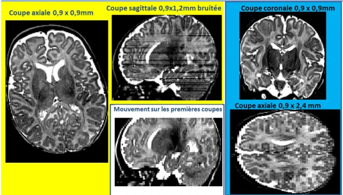 Figure  13.  Qualité  du  contraste  dans  trois  images  IRM  (cadres  jaune,  bleu  et  blanc)  du  cerveau  d’un  nourrisson