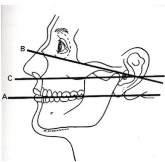Figure 4 : Un occluseur avec empreintes sectorielles. 