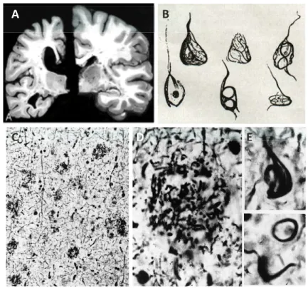 Figure 1. Lésions neuropathologiques caractéristiques de la Maladie d’Alzheimer. 