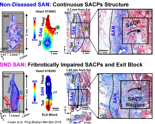 Figure 4. Functional and structural imaging of human SAN with history of SND  