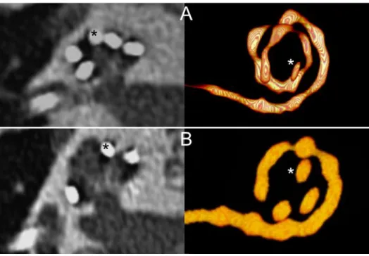 Figure  2:  Variability  of  the  angular  depth  of  insertion  among  cochleae  with  complete  array  445 