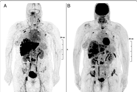 Fig. 2 PET imaging of a patient with metastatic breast carcinoma. a Pretargeted immuno-PET performed using the TF2 anti-CEA bispecific antibody and the 68 Ga-labelled IMP-288 peptide detects more lesions than FDG-PET (b)