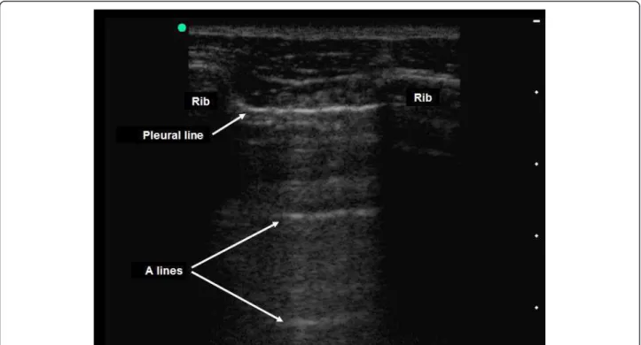 Figure 3 Pleural ultrasonography in two-dimensional mode [31]. The pleural line is seen between two ribs