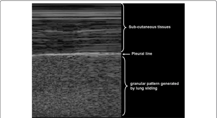 Figure 4 Assessment of lung sliding on pleural ultrasonography in time-motion mode on a patient without pneumothorax [31]