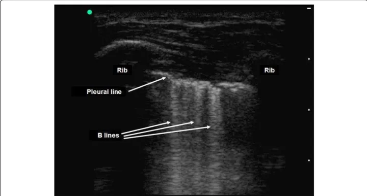 Figure 6 Detection of B-lines on pleural ultrasonography in two-dimensional mode. The presence of vertical linear artefacts arising from the pleural line (B-lines or comet-tail artefacts) rules out pneumothorax in this patient with interstitial syndrome
