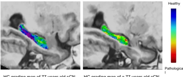 Figure 3: Examples of hippocampal grading maps obtained on the Bdx-3C dataset for a sCN  subject and a cCN subject 7.5 years before conversion to AD