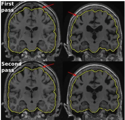 Fig. 8. Examples of ADNI brain masks produced by BEaST not passing the quality control in the  first  pass  (first  row)  and  passing  the  quality  control  after  second  pass  (second  row)