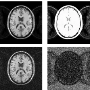 Fig. 2. Top. Right: Simulated ghosting artefacts on brainweb with 20% inhomogene- inhomogene-ity