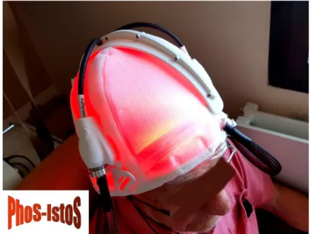 Figure 12: image of the helmet delivering an irradiance of 1.3mW/cm² for 150 minutes for the  treatment of Actinic Keratosis 