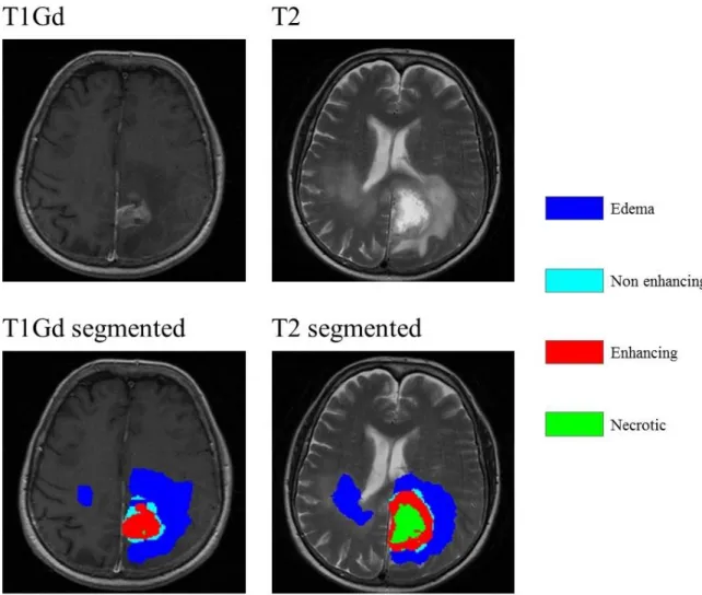 Fig.  7  Automatic  GBM  segmentation  generated  with  the  software  BraTumIA  (Brain  Tumor  Image  Analysis)[94]