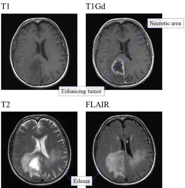 Fig. 2Illustration of four different MRI modalities of the same clinical case: T1 in the top left-hand corner, T1Gd  in  the  top  right-hand  corner,  T2  in  the  bottom  left-hand  corner  and  FLAIR  in  the  bottom  right-hand  corner  (DICOM  files  