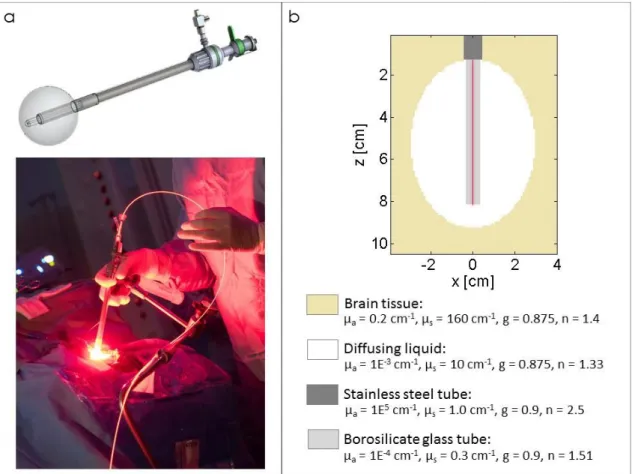 Figure 3: a) Lighting applicator in which the fiber guide is inserted into the balloon to guide the 70  mm cylindrical diffuser and its clinical application