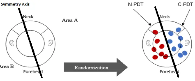 Figure 4 : Schematic of the randomizaton process for area A en area B. C-PDT : Aktilite CL128 device,  N-PDT : Flexitheralight device 