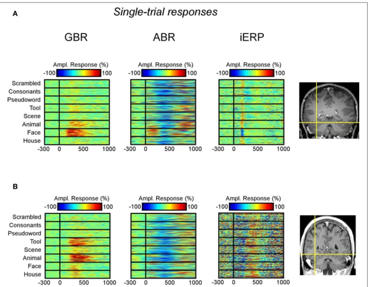 Figure 6 shows the spatial distribution of SI for GBR, ABR, and  iERP. All recording sites which elicited a SI >1 for GBR, ABR, or  iERP formed a statistically significant cluster within the posterior  temporal cluster (for all neural markers, left and 