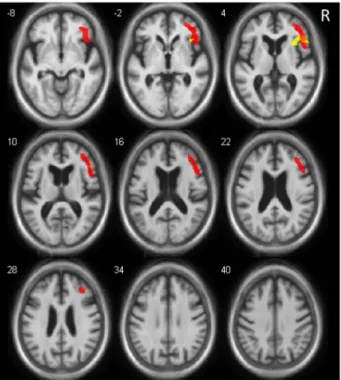 Figure 3. Brain Regions with Relative Hypometabolism (red) and Relative Gray Matter Atrophy (yellow) in Relation with Hallucinations