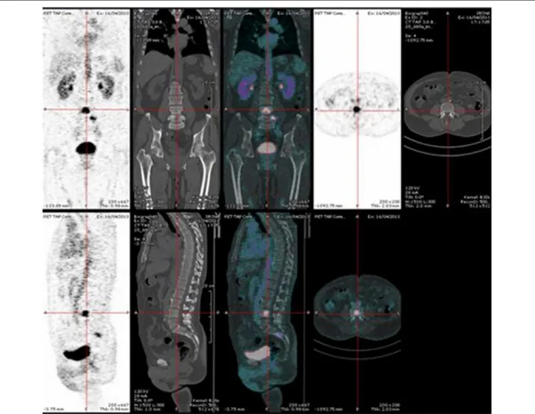 FIGURE 2 | Pretargeted immuno-PET recorded after injection of 120 nmol of TF2 and 6 nmol of 68 Ga-IMP-288 at 30 h in a patient with a relapse of MTC