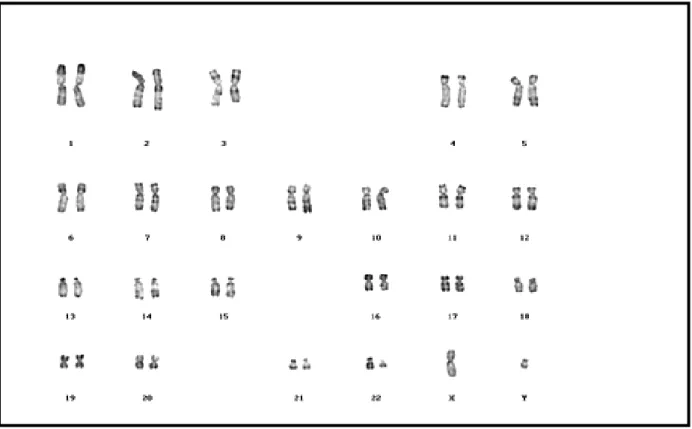 Figure 3 : Le Caryotype a la phase chronique avec le chromosome  Philadelphie (chromosome 22 court) 