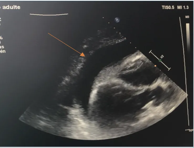 Figure 1 - Épanchement péricardique à l’échographie trans-thoracique