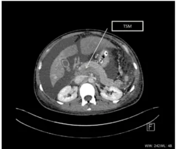 Fig. 3 Coupe axiale au temps portal : thrombose du tronc spléno- spléno-mésaraïque étendue au tronc porte