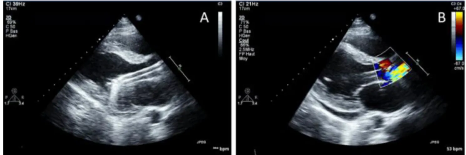Fig. 7 Échocardiographie transthoracique en incidence parasternale grand axe gauche montrant une Impella ® correctement positionnée.