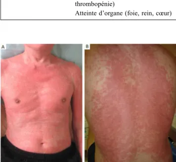 Fig. 5 Aspects cliniques évocateurs de DRESS syndrome. A. Éry- Éry-throdermie à la phase aiguë d ’ un DRESS