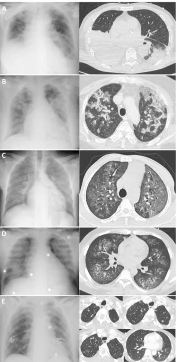 Fig. 2 Aspects radiologiques et scanographiques de pneumonies infectieuses chez le transplanté rénal