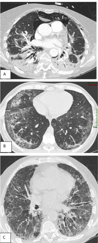 Fig. 2 Coupes transversales de scanner thoracique en fenêtre parenchymateuse de patients ayant une pneumopathie interstitielle diffuse associée à une myopathie inflammatoire idiopathique