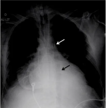 Fig. 1 Cliché de radiographie thoracique montrant la position correcte d ’ un ballon de contre-pulsion dans l ’ aorte, avec son opacité dis- dis-tale radio-opaque en regard du bouton aortique (flèche blanche), et son gonflage dans l ’ aorte en diastole (fl