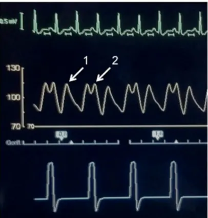 Fig. 2 Exemple d ’ un écran externe de BCPIAo réglé en 1 sur 2 sur le cycle cardiaque, montrant (A) l ’ électrocardiogramme du patient, (B) sa pression artérielle invasive, (C) les cycles de gonflage et dégonflage du ballon