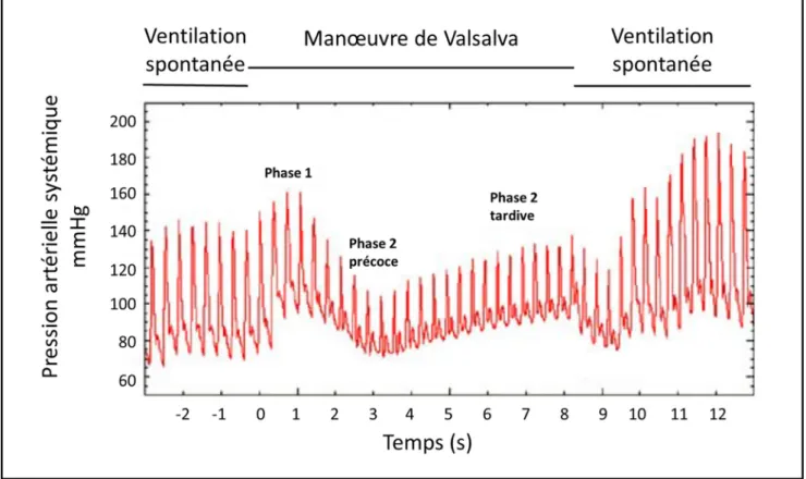 Fig. 2 Évolution de la pression artérielle systémique au cours d ’ une man œ uvre de Valsalva