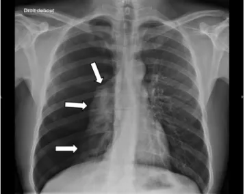 Fig. 2 Radiographie thoracique de face : pneumothorax gauche de faible abondance. On visualise une hyperclarté en croissant à l ’ apex gauche avec une discrète ligne bordante (flèches)