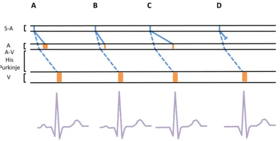 Fig. 4 Relation entre l ’ ECG et une représentation du PA se propageant dans le tissu nodal, les voies de conduction, les muscles auricu- auricu-laires et ventricuauricu-laires au cours d ’ une hyperkaliémie