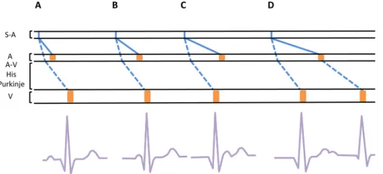 Fig. 5 Hyperkaliémie et aspect de préexcitation à l ’ électrocardiogramme et diagramme représentant le potentiel d ’ action se propageant dans le tissu nodal, les voies de conduction, les muscles auriculaires et ventriculaires
