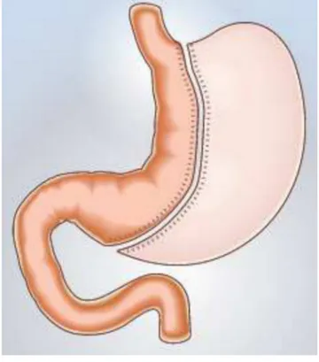 Fig. 1 La sleeve gastrectomie (© HAS)