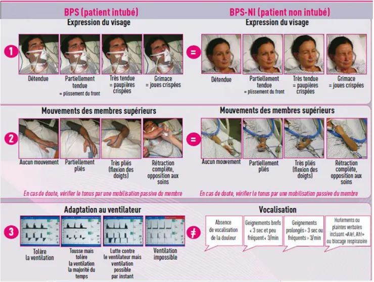 Fig. 2 Patients non communicants intubés ou non intubés : hétéroévaluation de la douleur par l ’ échelle comportementale BPS/BPS – NI